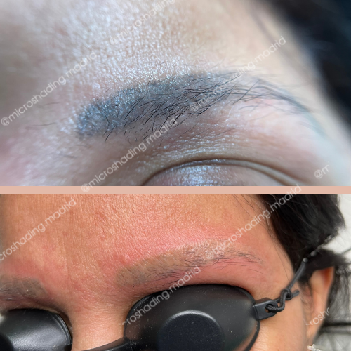 Son muchas las clientas que llegan para eliminar el microblading con la idea de que les mostraron resultados muy diferentes. Recuerda: el microblading nunca se ve como vellos naturales y siempre cambia de color, ya sea a un tono gris como en la foto o a un color rojo, especialmente en piel grasa y porosa. En la segunda foto, se muestran los resultados de una sesión de eliminación con láser de microblading y micropigmentación.