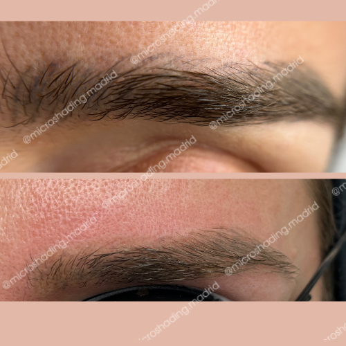 Eliminación del microblading con efecto de pelitos de color gris utilizando láser. Si deseas saber más, ¡síguenos en Instagram @microshading.madrid y en TikTok @microshadingmadrid!