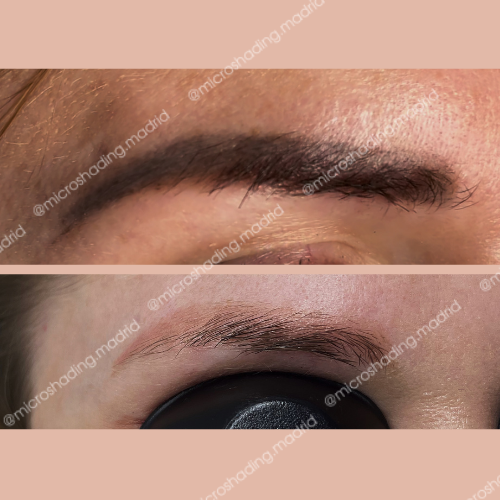 Eliminación de microblading después de 1 sesión de láser.