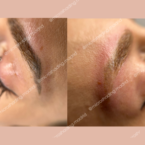 Eliminación de microblading gris en solo 1 sesión con láser. Si la clienta lo desea, se puede realizar una segunda eliminación con removedor entre 2 y 3 meses después de la primera sesión para lograr un resultado aún más limpio.